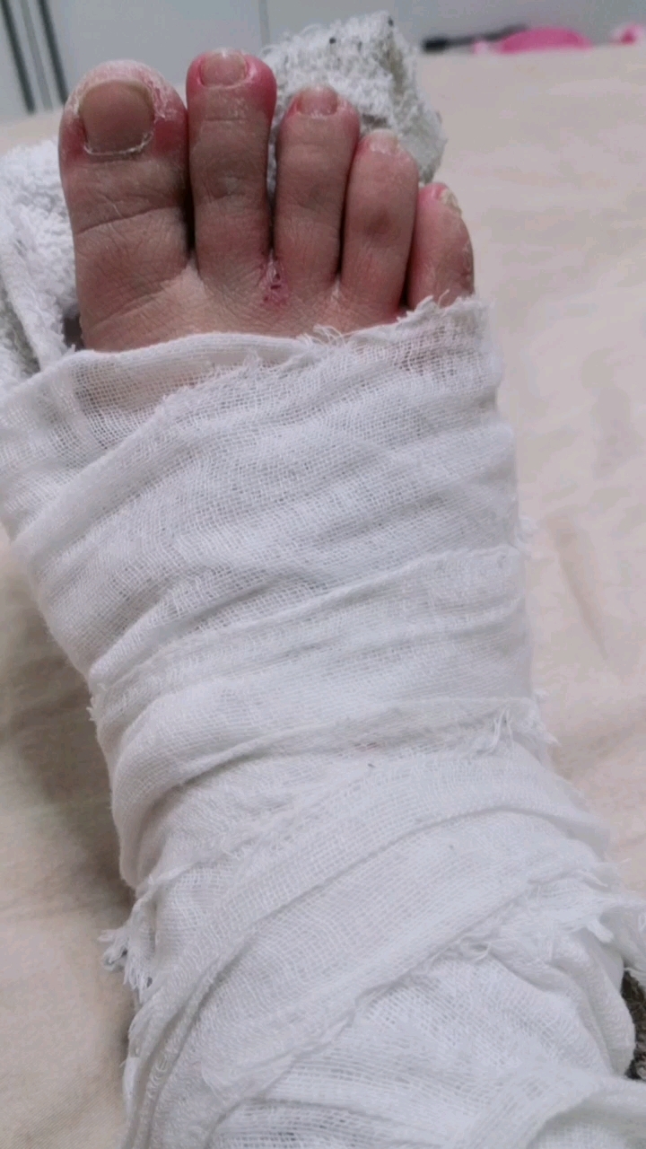 脚踝内,外,骨折后跟骨裂第47天