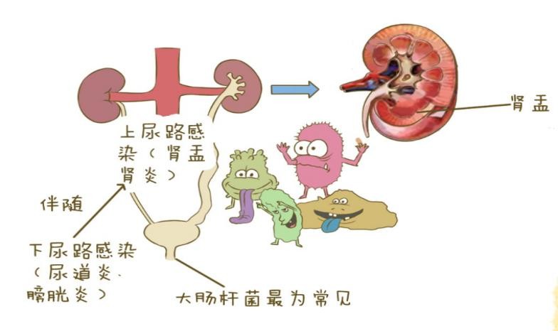 哪些原因会导致肾盂肾炎出现?患者在生活中要养成哪些习惯?