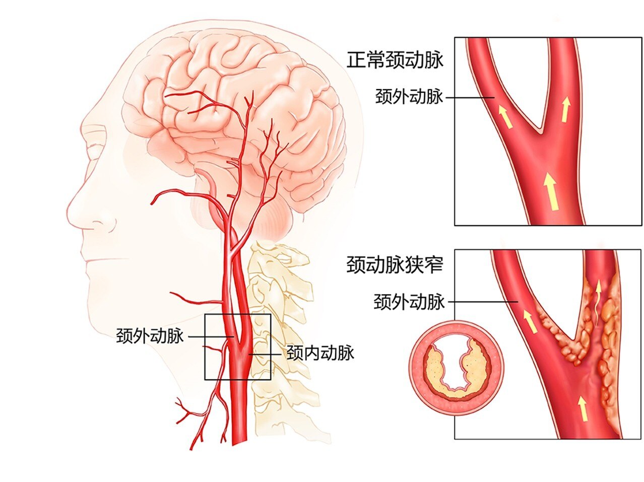 颈动脉狭窄被称为"隐形杀手,发现症状及时就医,预防是关键