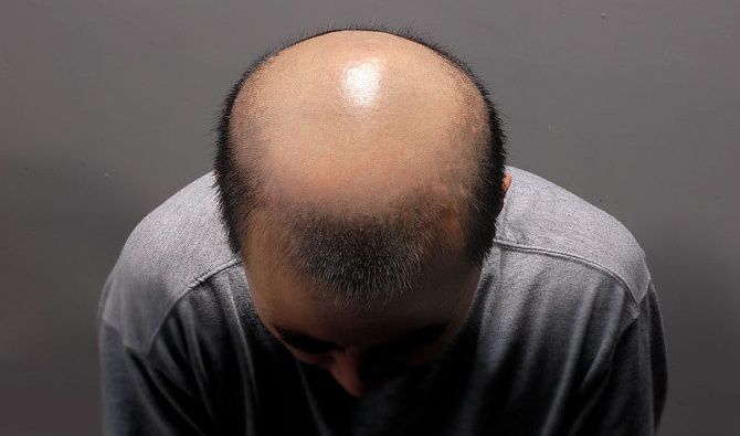 整个头顶植发需要多少钱 影响 效果的三大因素