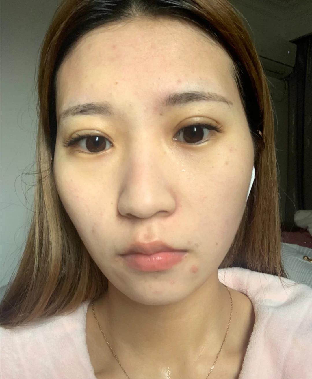 26岁女子皮肤暗沉"脏兮兮"!提醒:洗脸也有"姿势",别大意