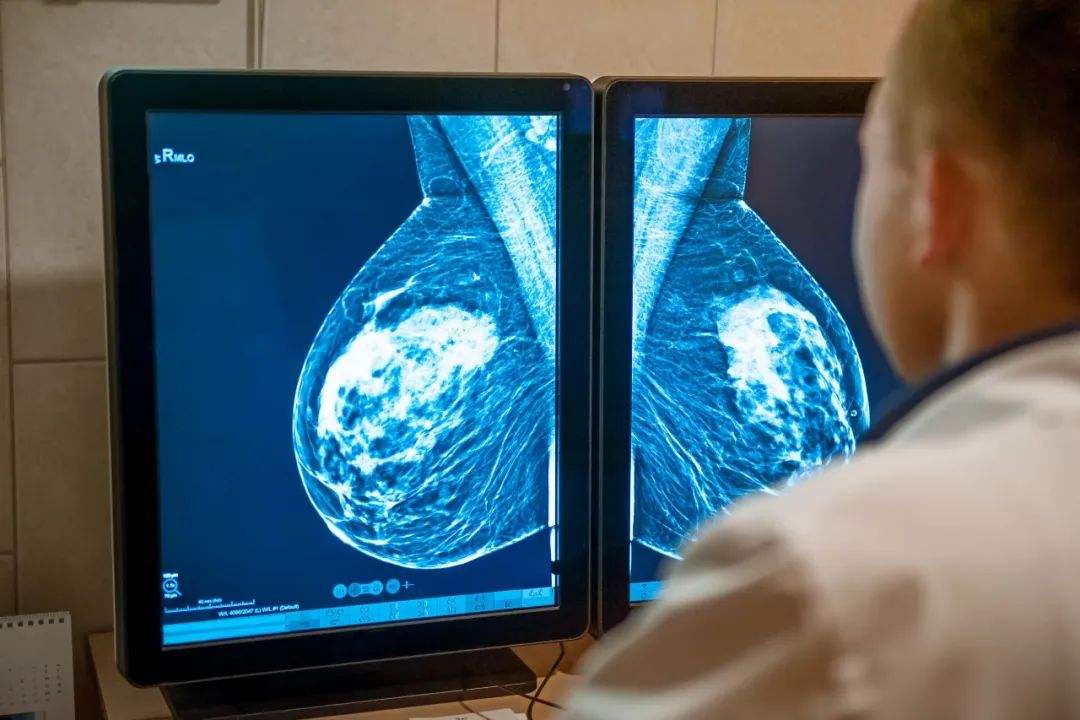 炎性乳腺癌案例图片图片