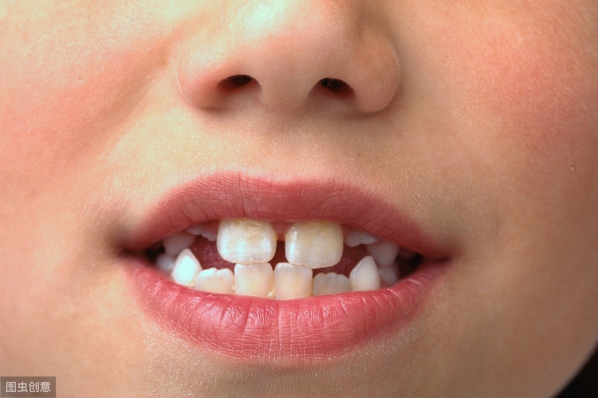 明星也相继去整牙了!牙齿不齐的你还无动于衷吗