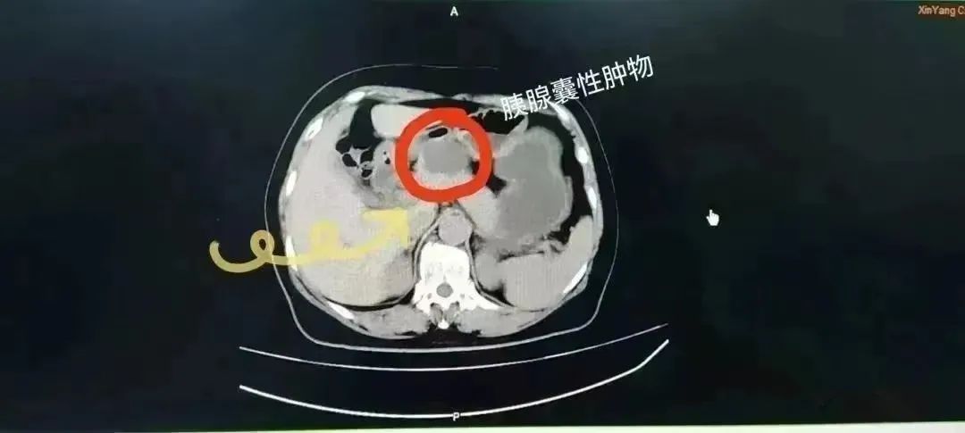 信阳市中心医院普外科二病区成功实施全腹腔镜下胰腺囊腺瘤切除术