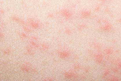 什么是玫瑰糠疹?患者有哪些饮食禁忌,3物要忌口