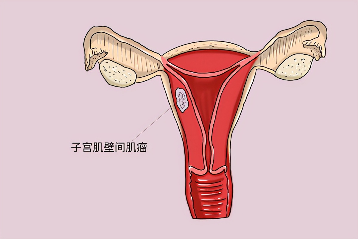 子宫腺肌症的症状有哪些?帮你一一解答