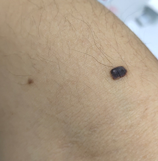 推荐速低头，找痣！知名医生：长在这些地方的都要切除！