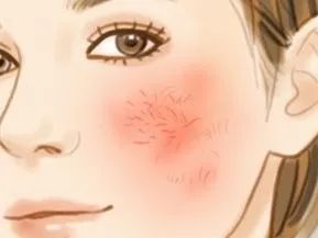 问题肌肤修复!——红血丝