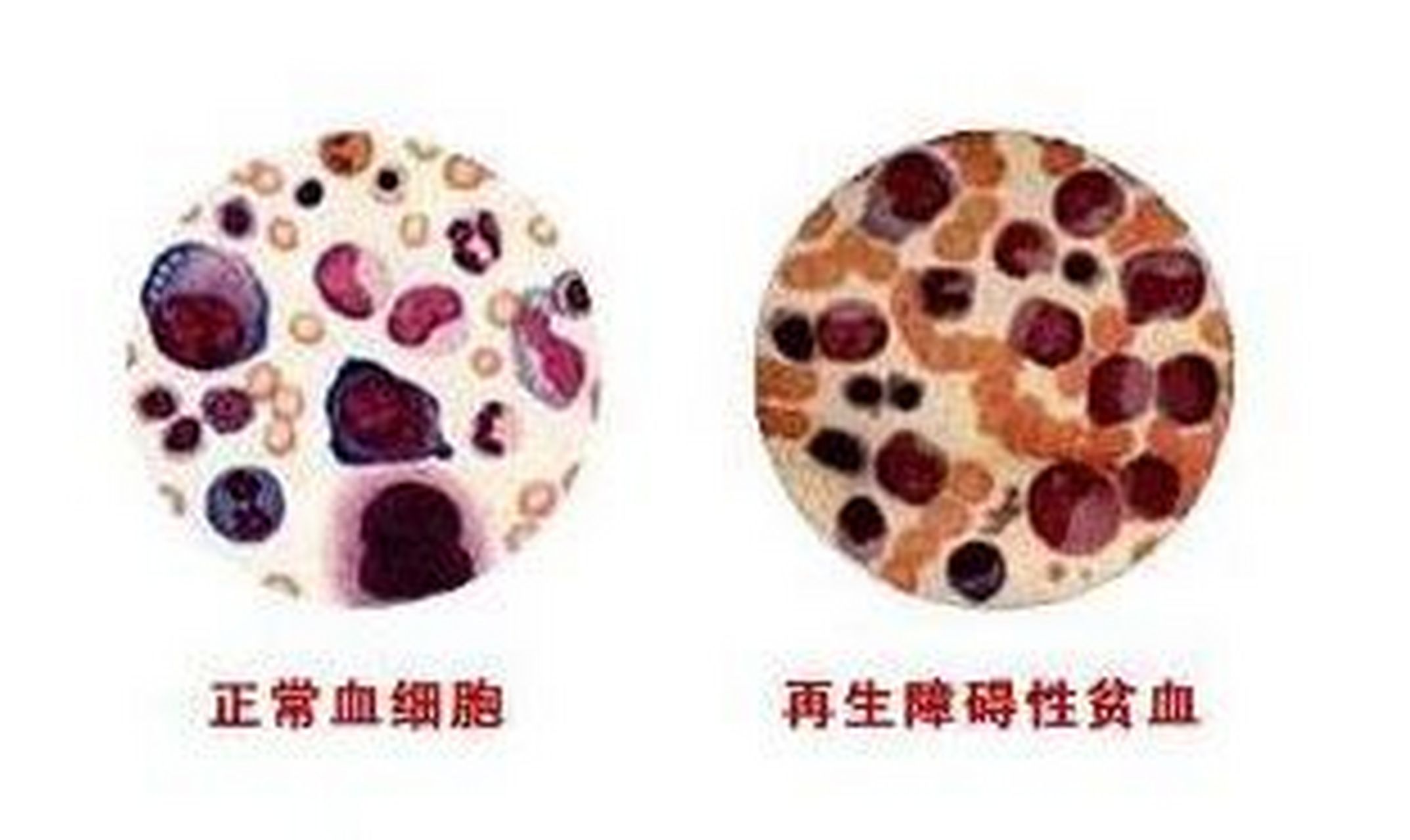 再生障碍性贫血的症状是什么?