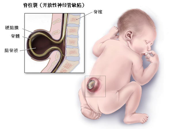 椎体隐裂图片