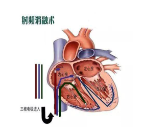 射频消融术原理示意图图片