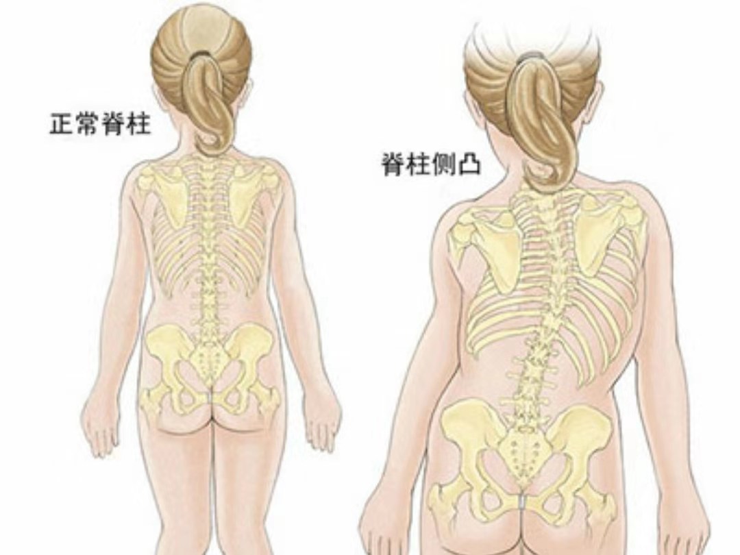 半椎體畸形是一種先天性疾病,患者的症狀多有脊柱側凸的狀況出現