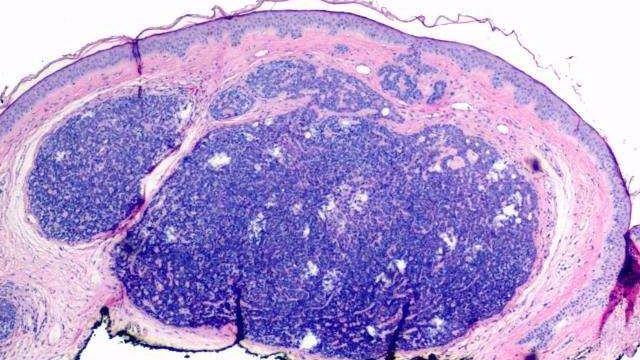 乳头状小汗腺腺瘤常见于黑肤色人,病因尚不明确,一般不会遗传