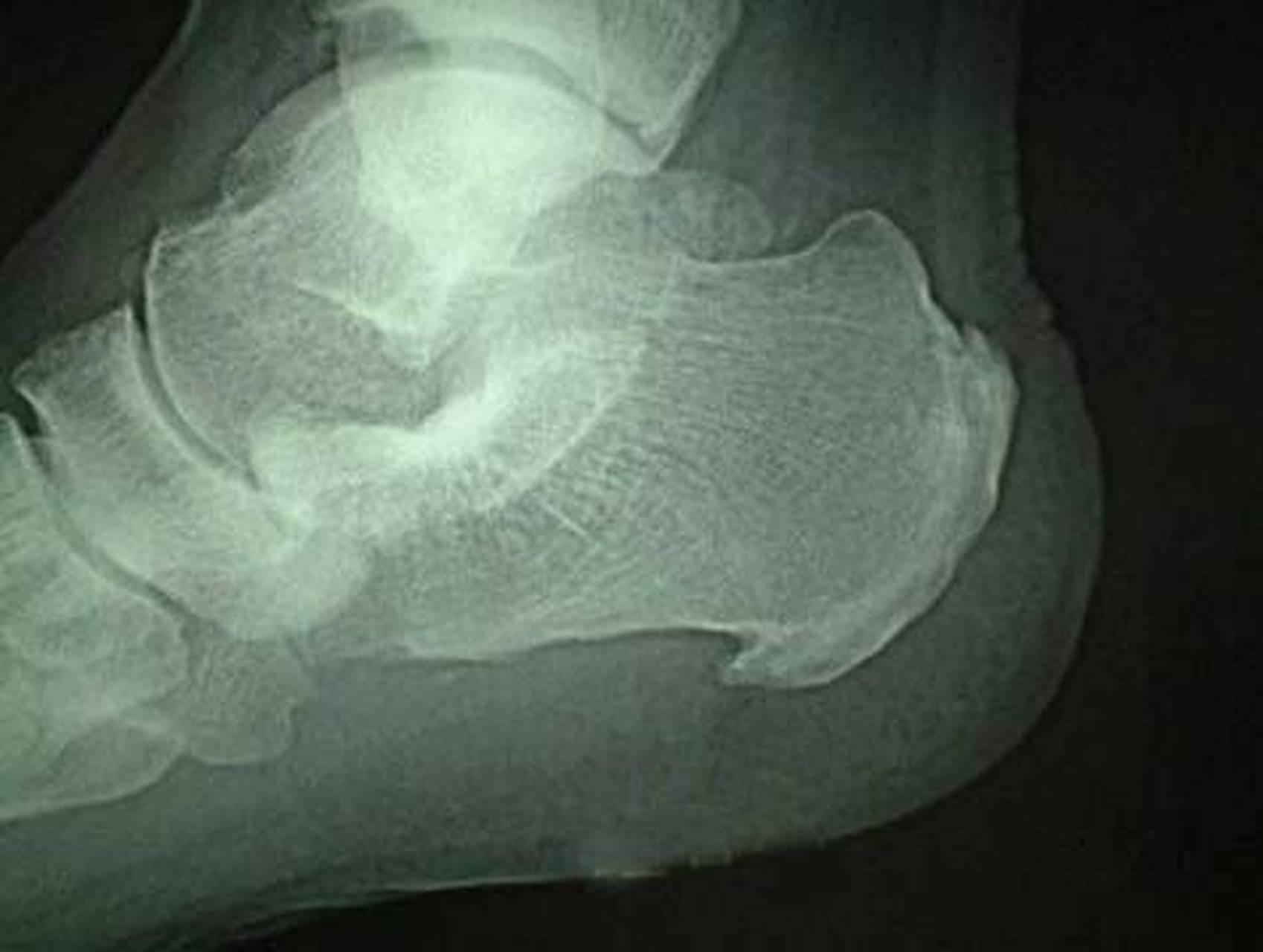 脚跟骨刺的形成多于足跟长时间的负重和磨损有关,当足跟关节出现