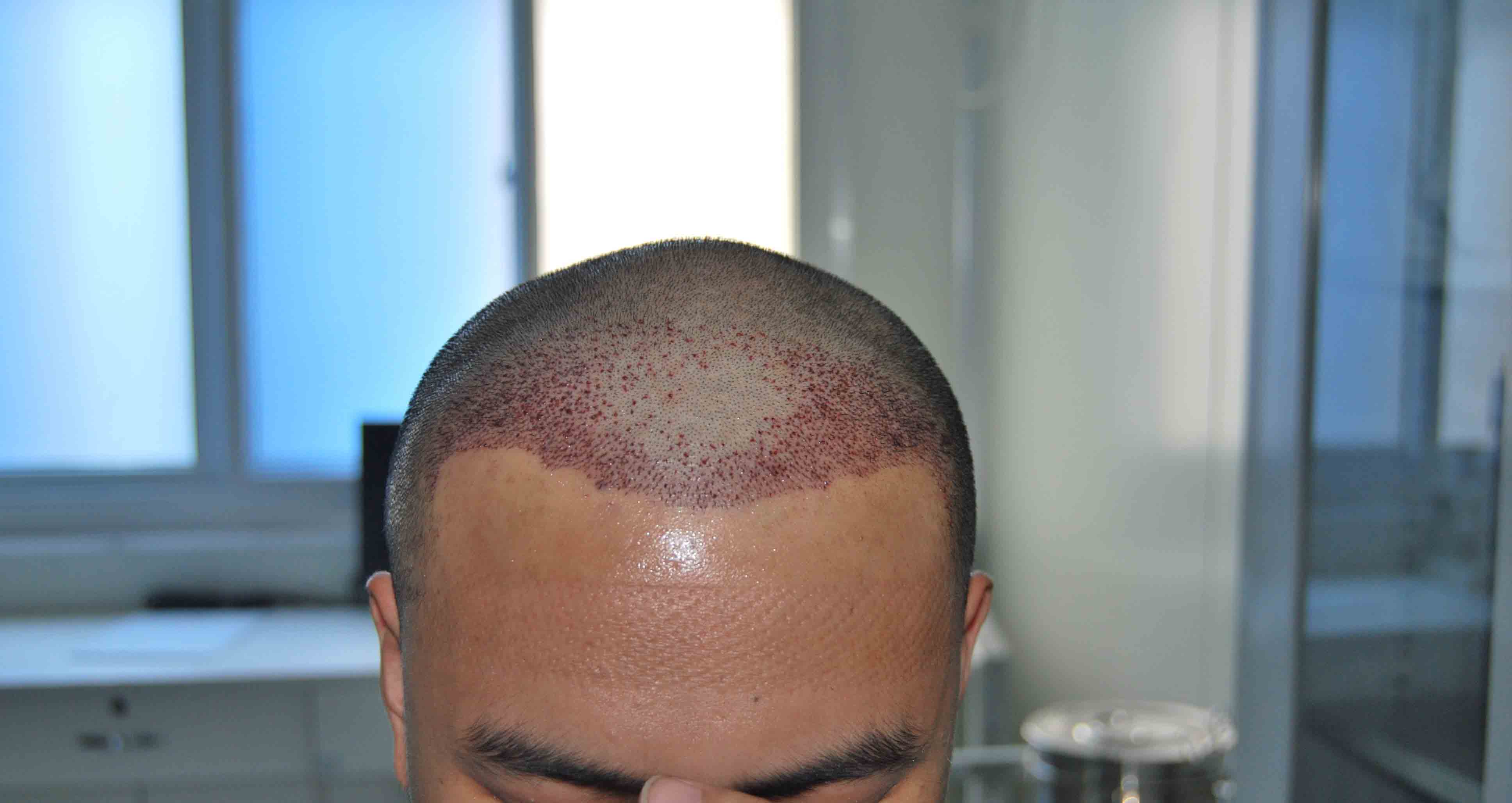 植发的过程,你知道多少,对植发手术又有哪些问题呢?