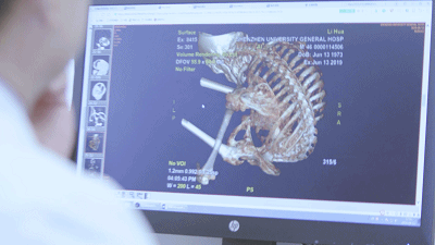 深圳大学总医院脊柱骨病科团队 4 次「粉身碎骨」的手术打开患者折叠的人生