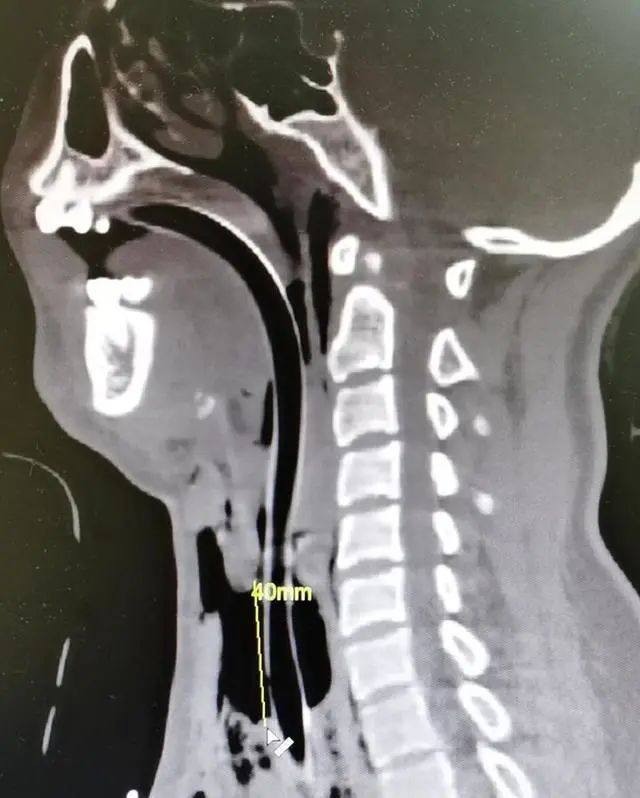 警戒线|飞来横祸！24岁姑娘骑电动车惨遭“割喉”，罪魁祸首万万想不到