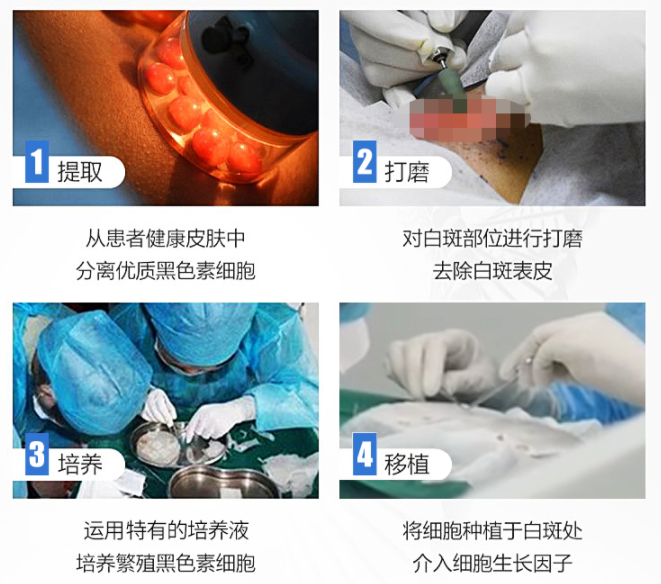 困擾6年的白斑在南通復大通過黑色素種植術複色