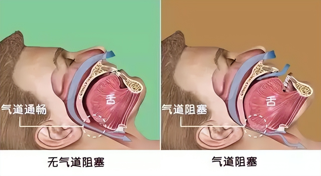 鼾声如雷?小心呼吸暂停综合征