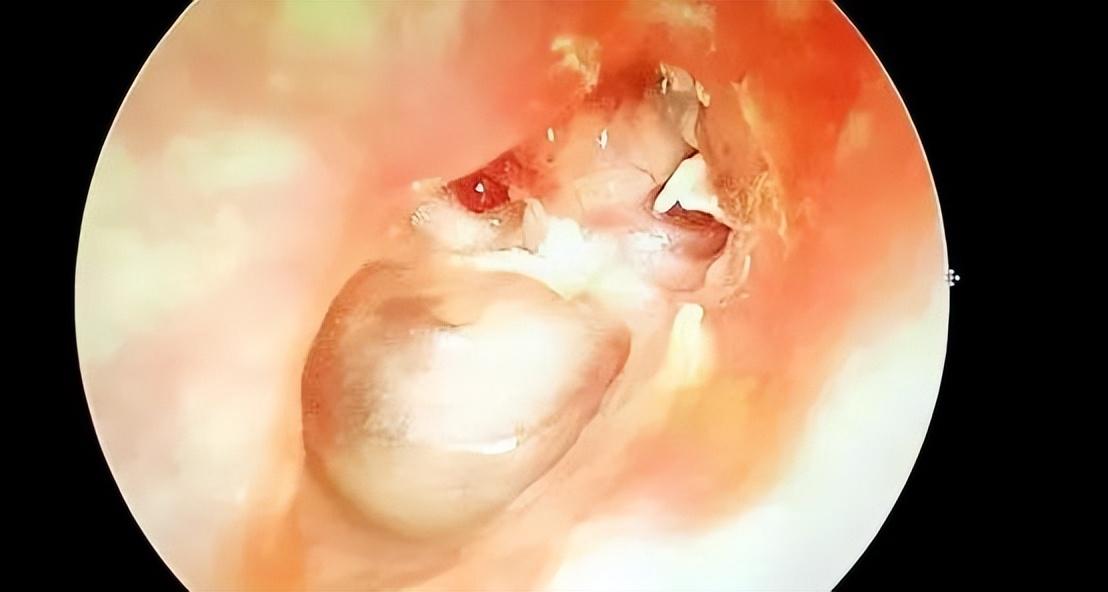 二十年耳朵流脓,听力障碍,郫医手术一朝根治,患者道不完的感激