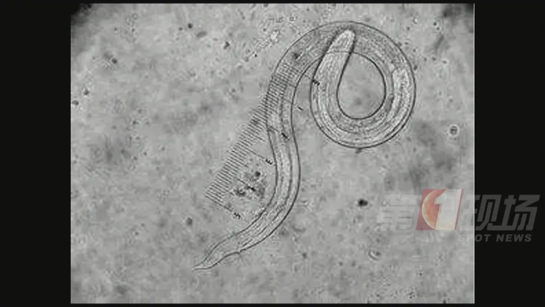 热点|深圳一小伙突然瘫坐路边，大小便失禁，原来是脑中布满虫子！