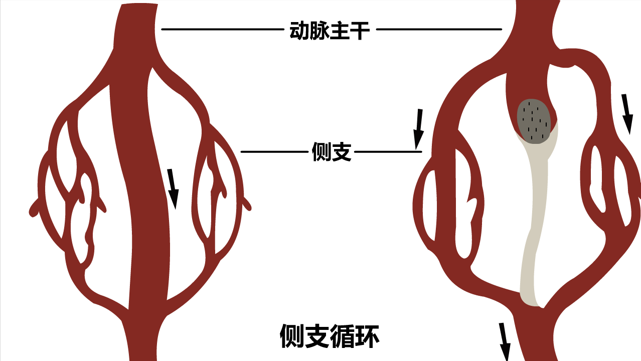 关于左冠状动脉异常起源于肺动脉,你了解多少?