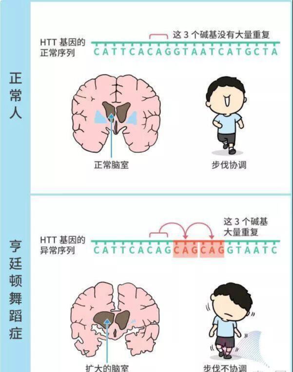 亨廷顿舞蹈病舞蹈症图片