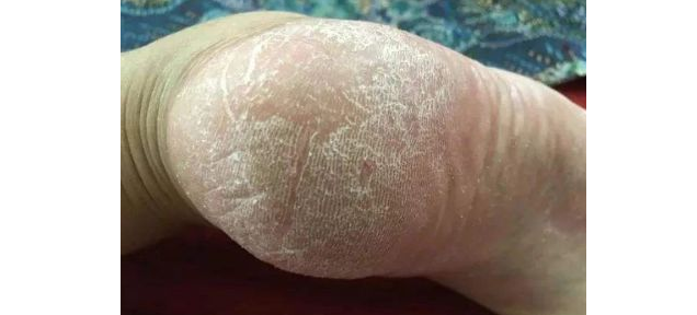 脚后跟干裂小腿长鱼鳞不是皮肤缺水病根在这条经一定要打通