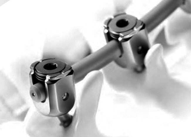 dynesys动态稳定系统,graf人工韧带graf人工韧带,isobar ttl