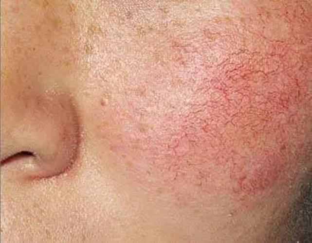 为何会有"红脸蛋",护肤品有用吗,有什么医美方法可以改善?