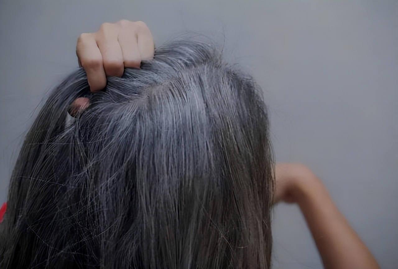 "少白头"不全是遗传所致,想要白发变黑,试试这四种方法