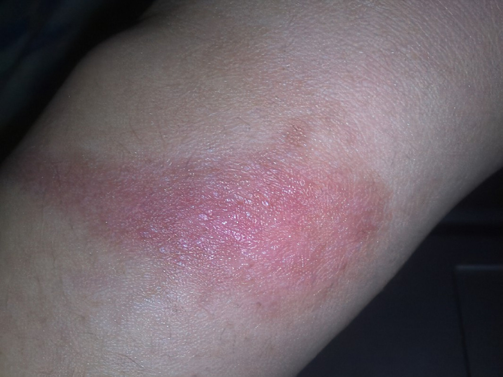 保持伤口清洁:伤口清洁是预防感染和疤痕形成的关键