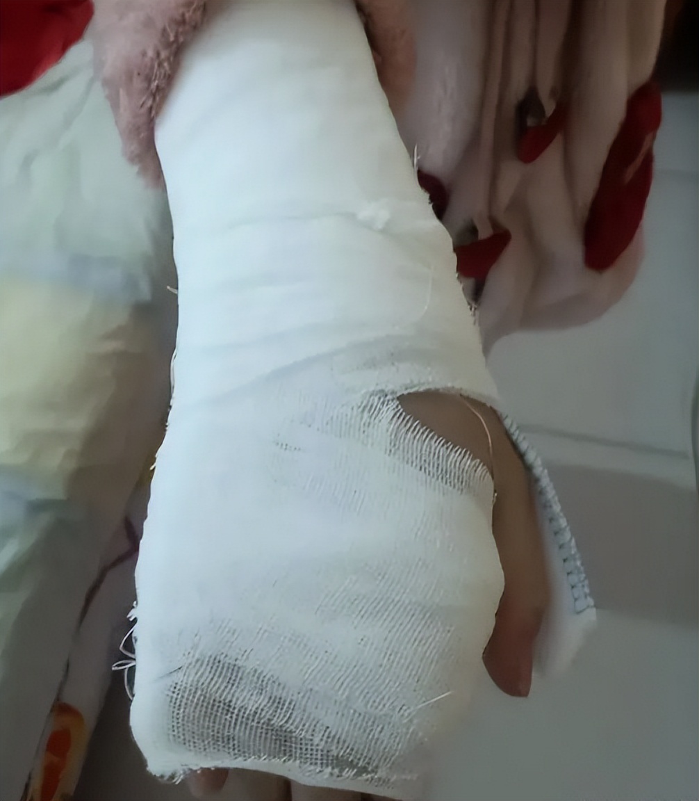 必须找学校报销!六年级女孩延时课回教室拿作业,摔倒骨折求解决