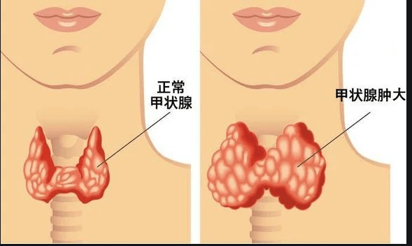 甲状腺肿大