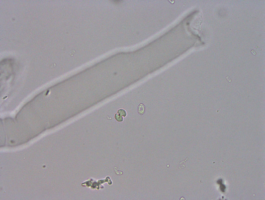 尿检图谱大合集:16张图片手把手教你辨认尿液中的草酸钙结晶