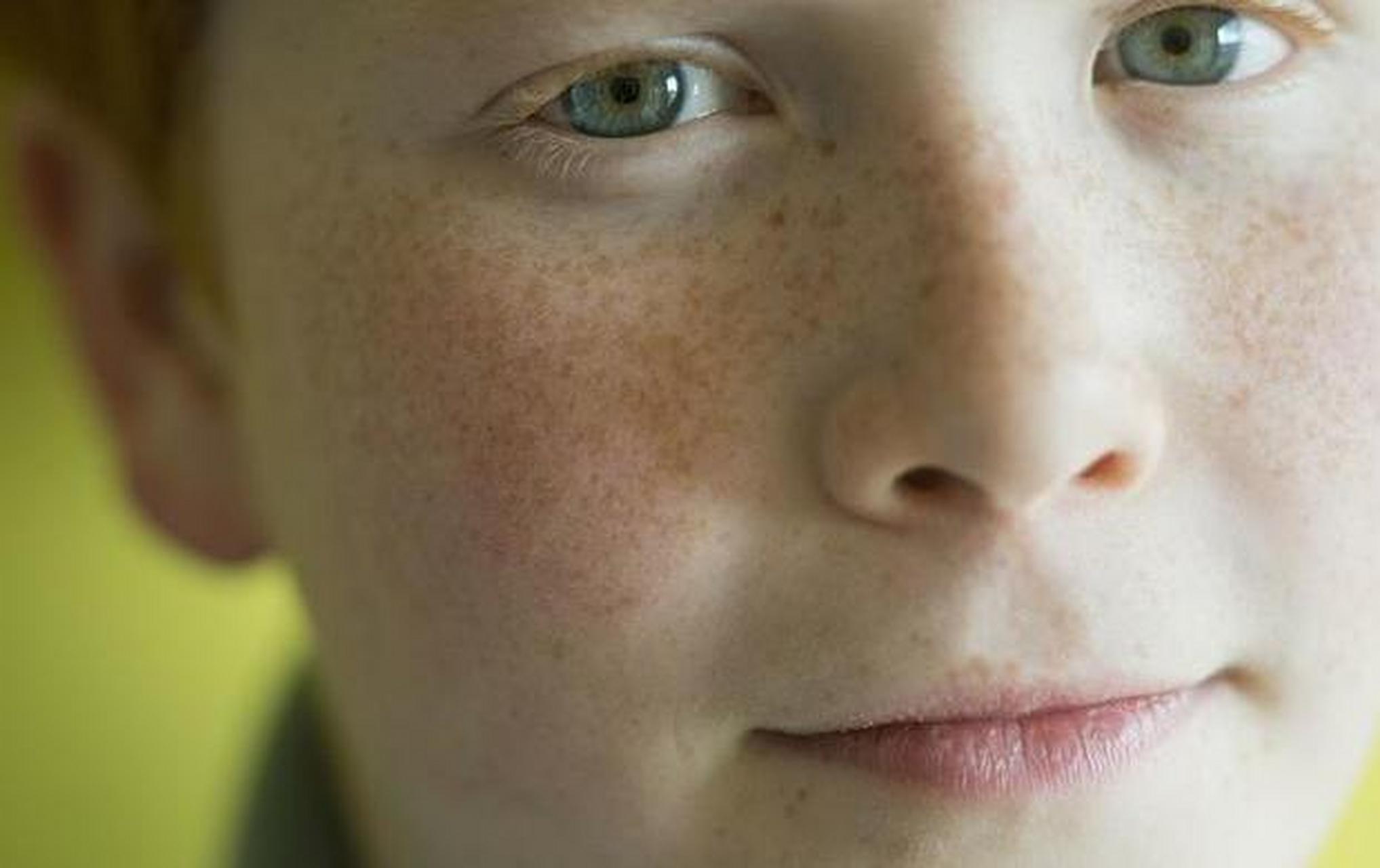 脸上色斑黑色素沉淀怎么去除 #医美科普挑战赛#   要想彻底去除额头黑