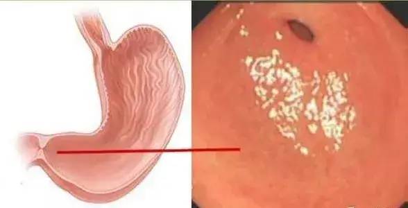 胃镜只是检查胃吗?一组图片告诉你胃镜多厉害
