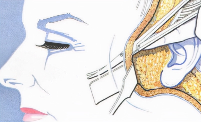 敢看吗:做拉皮的危害,做拉皮手术的后遗症,怕怕?