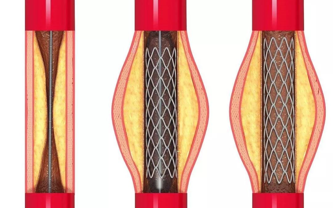心臟放了支架,還能活幾年?真的會影響壽命嗎?醫生告訴你大實話