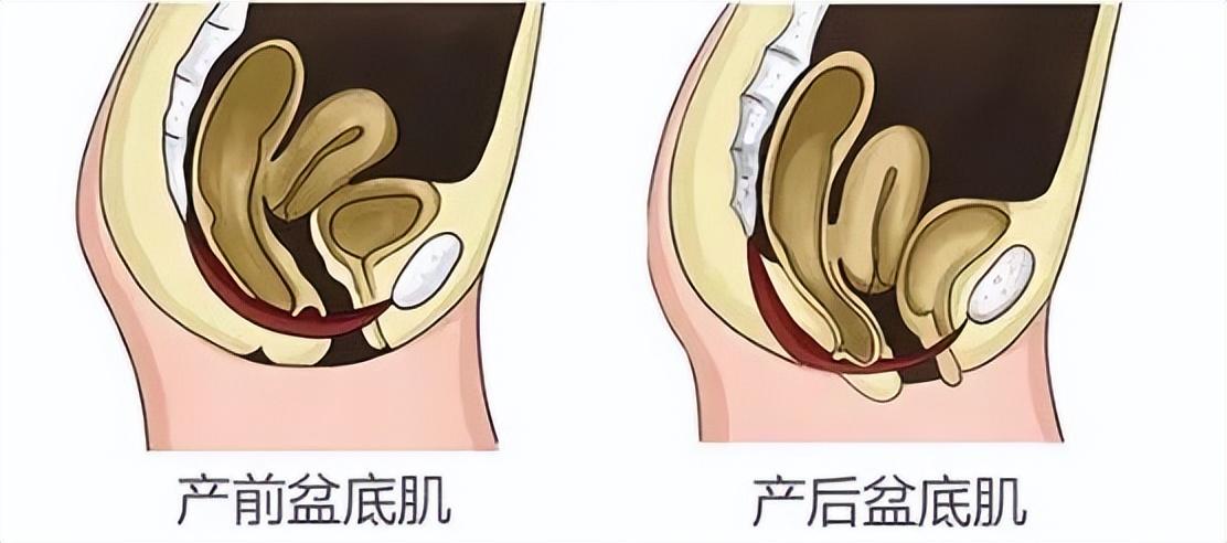 什么是阴挺?对身体健康有影响吗?不管有没有生孩子,都建议了解
