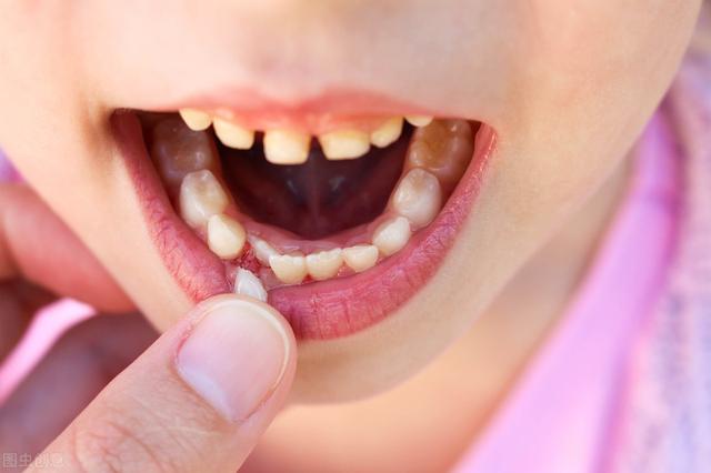 孩子长双排牙,一般是这4个原因造成,看看你家孩子有没有?