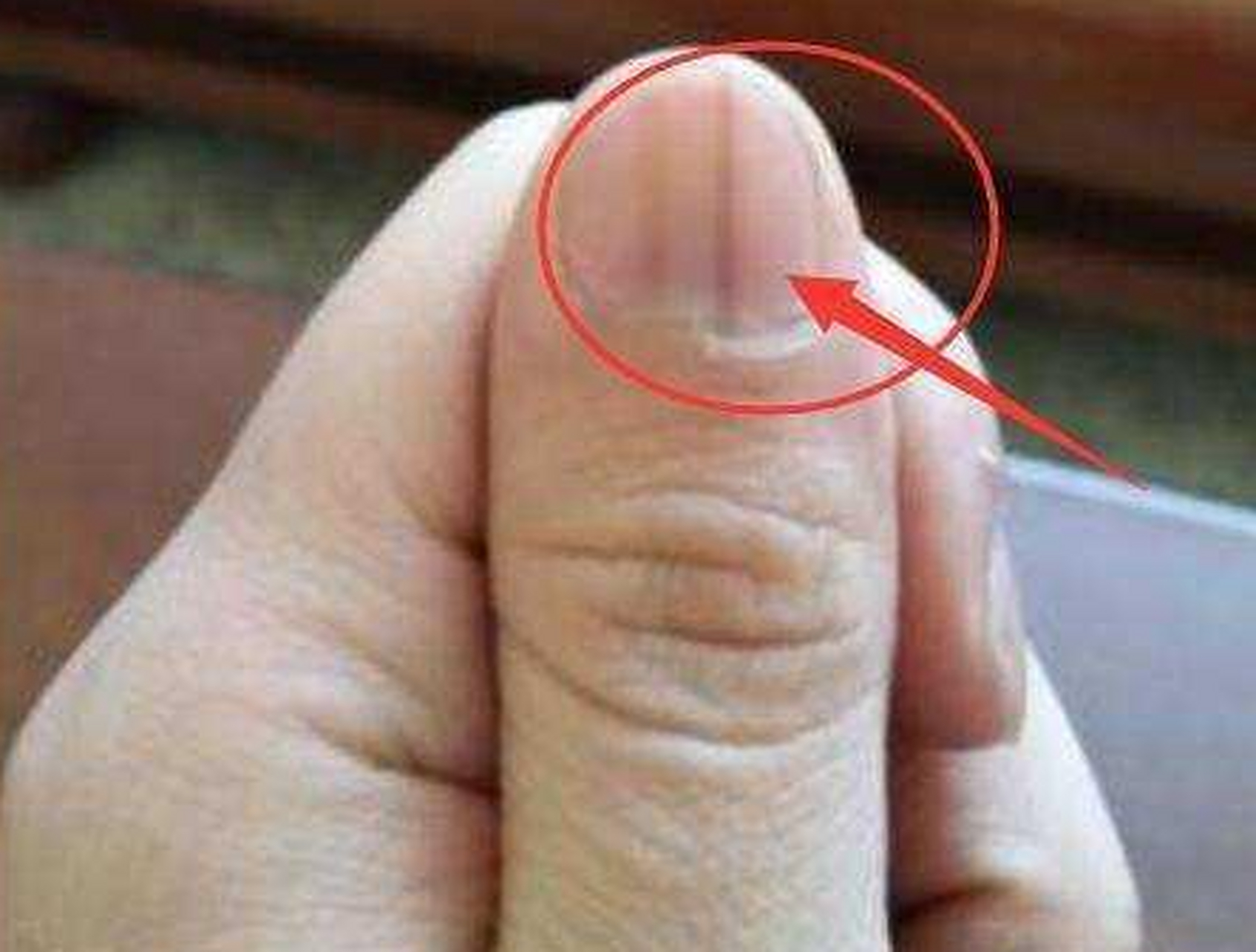 梁女士30岁,二胎孕14周,突然发现大拇指指甲有两条灰色的线,刚开始也
