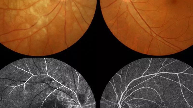 eales 病,一种特发性炎症性静脉闭塞性疾病,主要影响年轻人