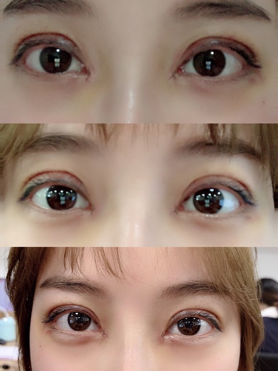 双眼皮宽度如何选择?大概费用是多少?