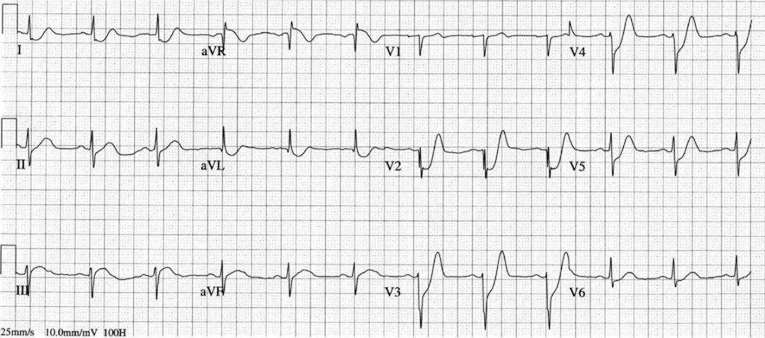 窦性心律心电图特点图片