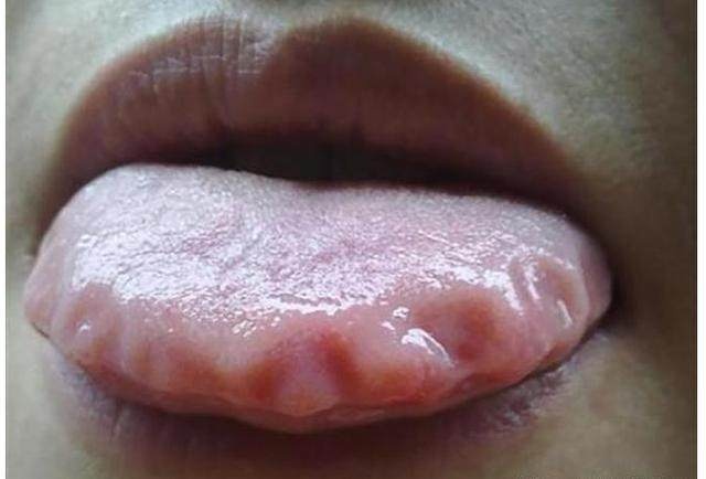 舌头发麻是什么病兆?提醒:舌头发麻应当注意5点,或助于恢复