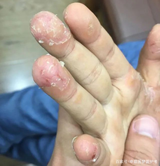 护士频繁戴手套，会损害皮肤吗？  第3张