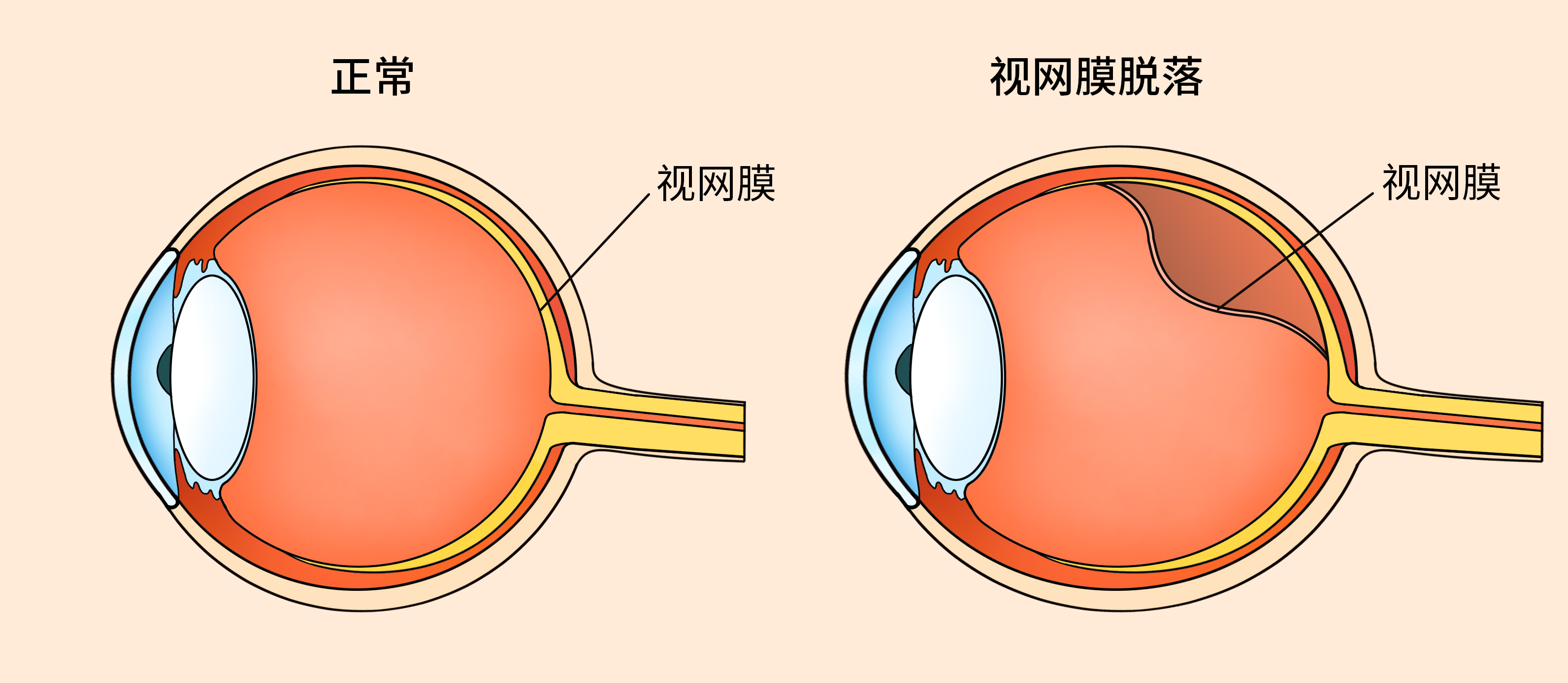 高度近视须警惕:长期用眼过度易致视网膜脱落