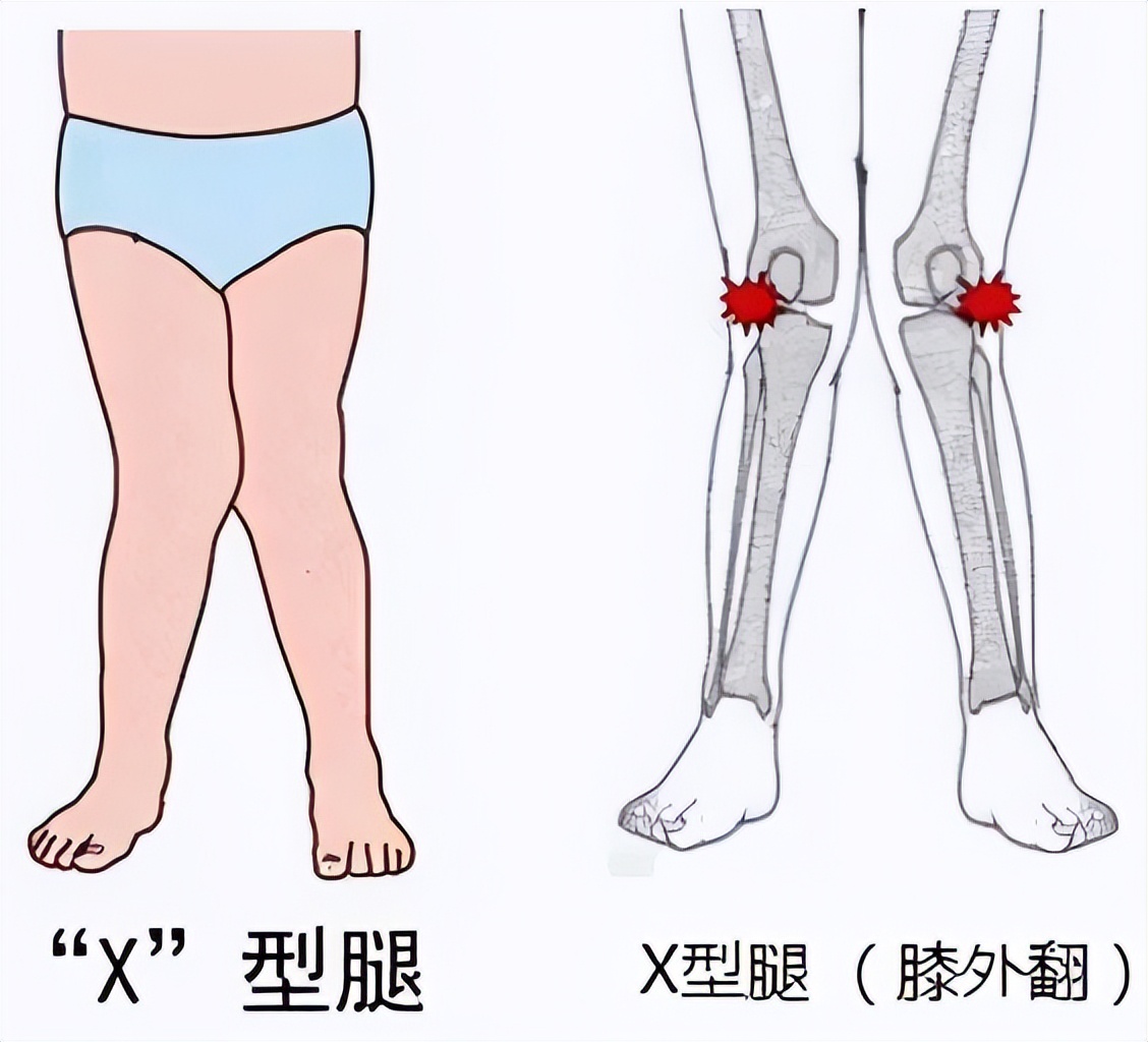 x型腿和o型腿 图示图片