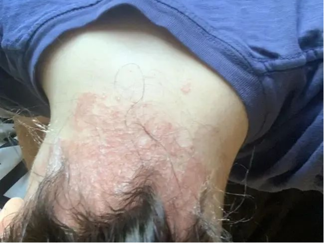 为什么有人对染发剂过敏?白发人的好物推荐!